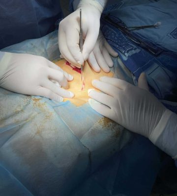 Пупкова грижа